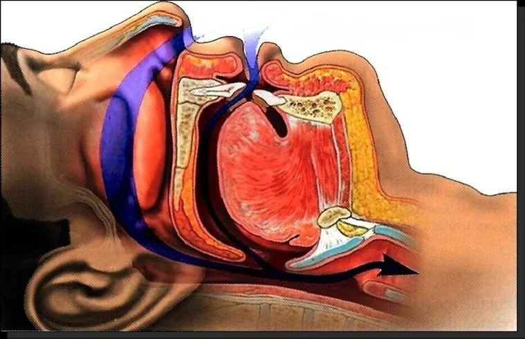 illustration of normal breathing intake without sleep apnea snoring Syracuse, NY