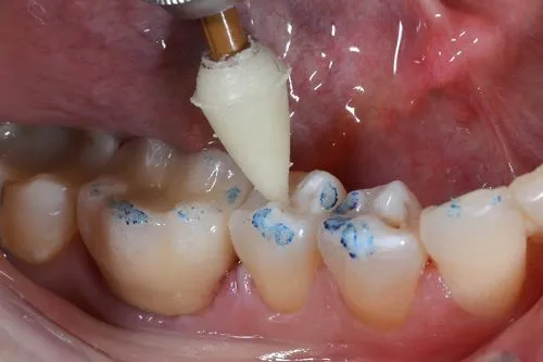 Occlusal Adjustment