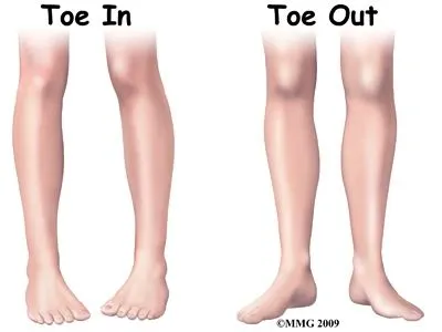 toronto_podiatrist__intoe_and_out_toe.jpg