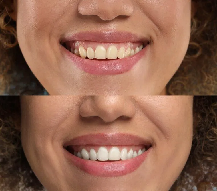 Teeth Whitening