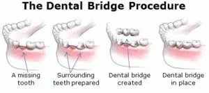 illustration of dental bridge procedure replacing teeth, dental bridge Elgin, IL dentist