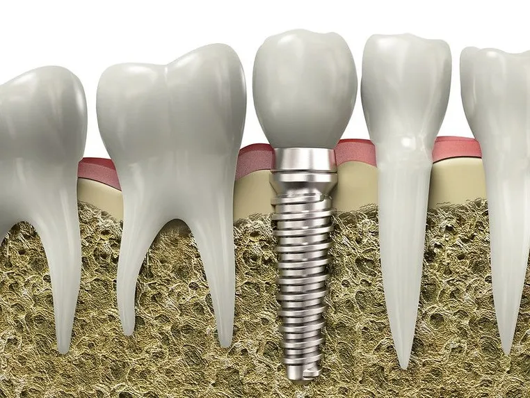 dental_implant