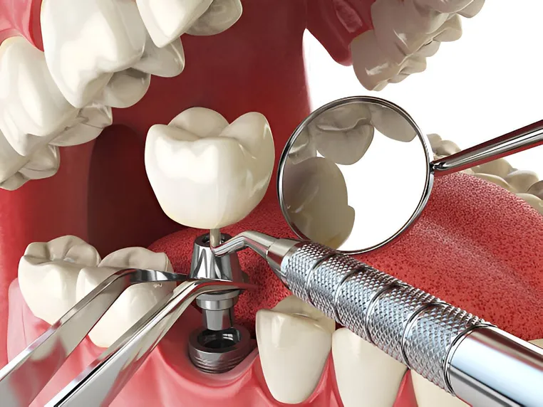 honolulu dental implants