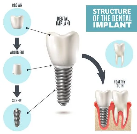 illustrated diagram Structure of the Dental Implant showing implant assembly, dental implants Baton Rouge, LA dentist
