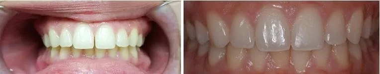 Before and After Invisalign Photos - by Dr. Avila