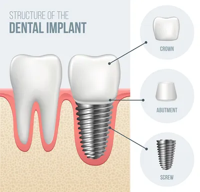 illustration "Structure of the Dental Implant" showing implant parts and assembly, dental implants Shelby, NC implant dentist