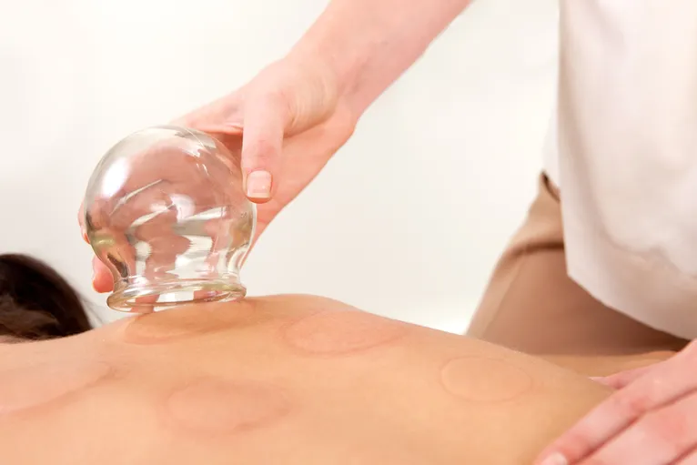 Cupping for Lower Back Pain, Does It Work?