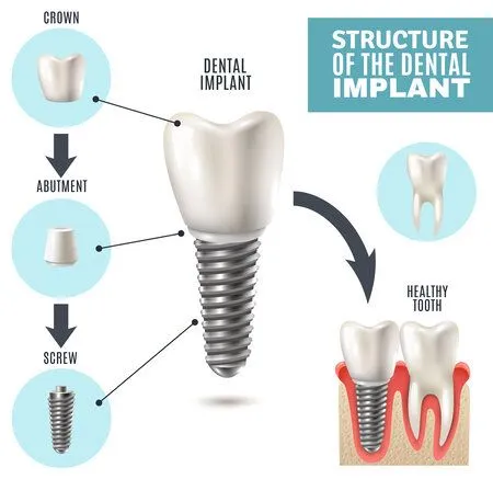 Illustrated diagram "Structure of the Dental Implant" showing implant parts and placement in gums, dental implants Old Bridge, NJ dentist
