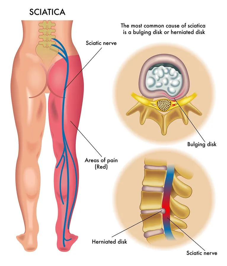sciatica treatment sheboygan Wi