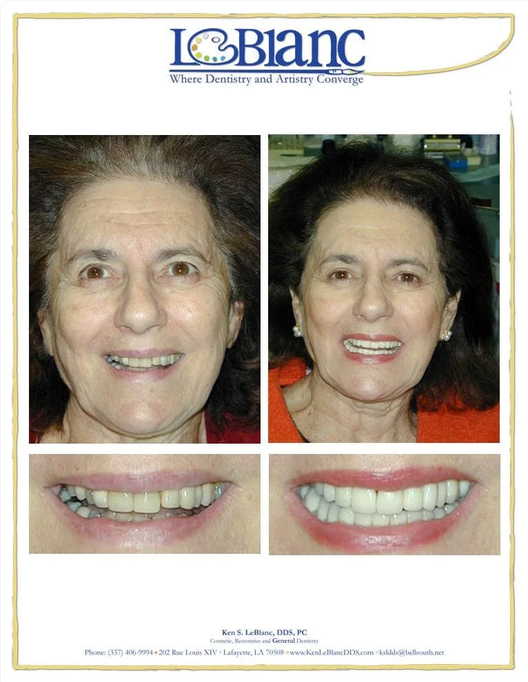 Dental Implant Restoration Lafayette