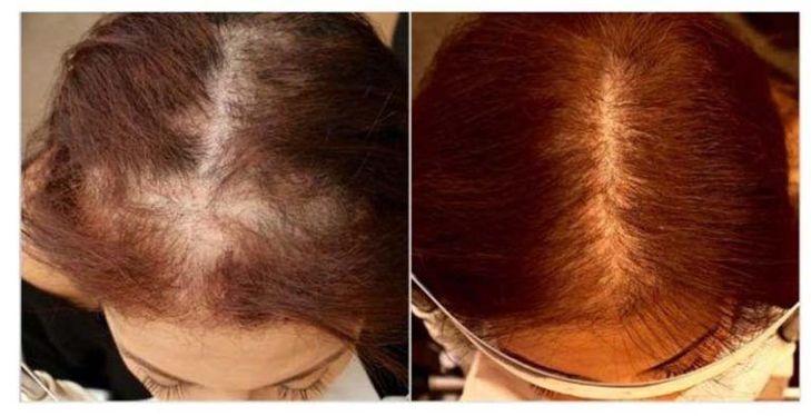 Hair Restoration Before and After Pictures - Plastic ...