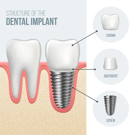 diagram showing dental implant parts and placement in jaw, implant dentist Hauppauge, NY dental implants
