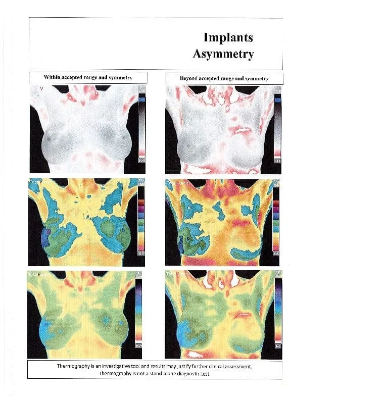 Thermography - Implants Asymmetry