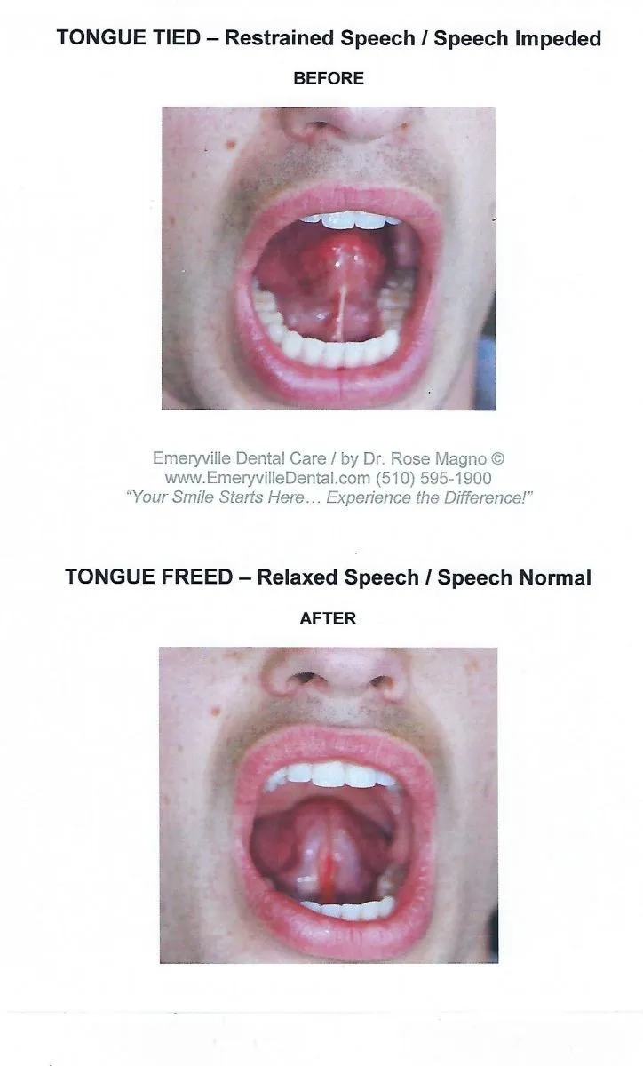 "Tongue Tied" patient Before and After Frenectomy