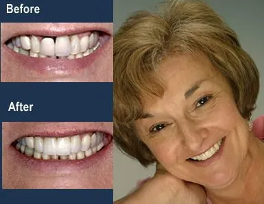 Anterior Porcelain Bridge