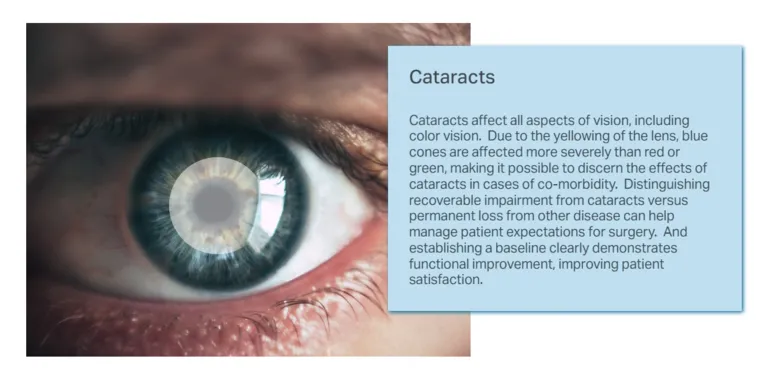 cataract