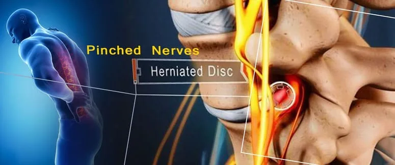 Herniated disc and nerves