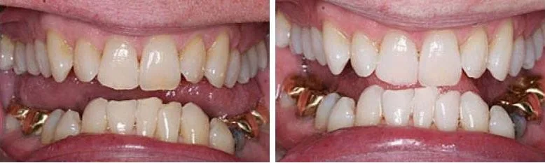  Tooth Whitening Example 2 Cedar Rapids, IA