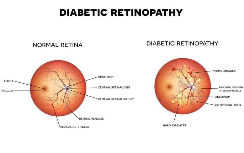 infographic of diabetic eye