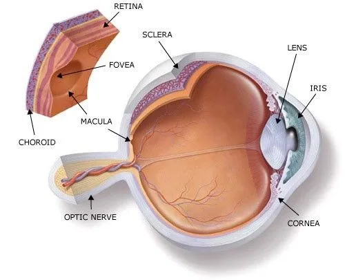 myopia