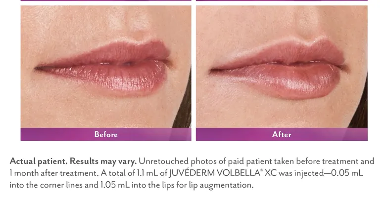 Juvederm-Volbella