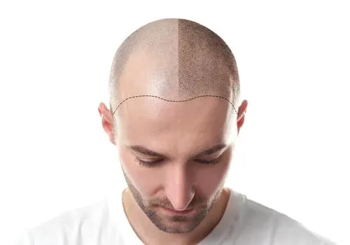 Man proudly showing results of hair loss treatment with improved hairline