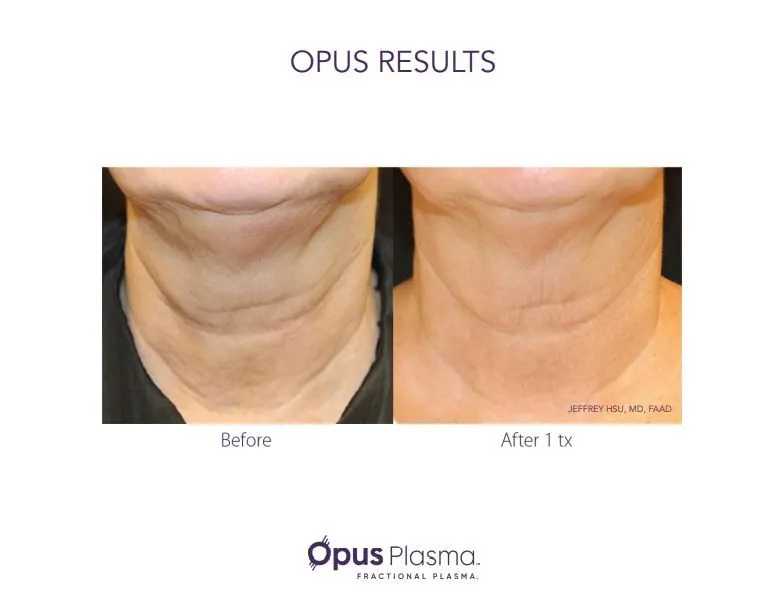 opus neck