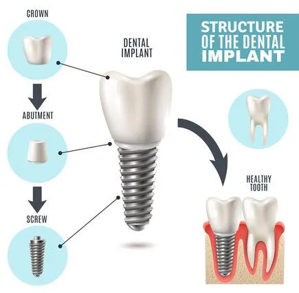 illustrated diagram "Structure of the Dental Implant" showing implant parts and placement, dental implants Westminster, MD dentist