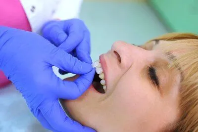 dentist's hands placing veneer pieces on woman's front teeth, veneers Peachtree City, GA family dentist