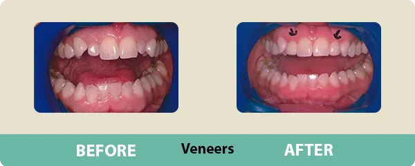 Veneers