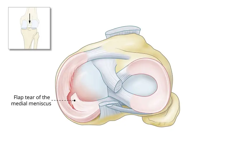 meniscus tear