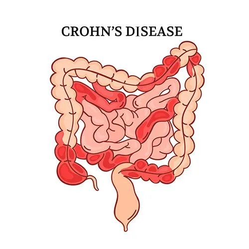 Illustration of Crohn's disease