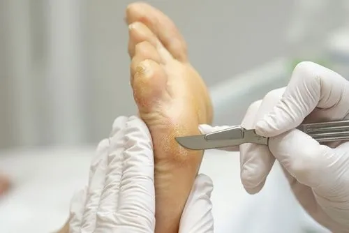 Podiatrist using a scalpel to remove a callus from a patient's foot