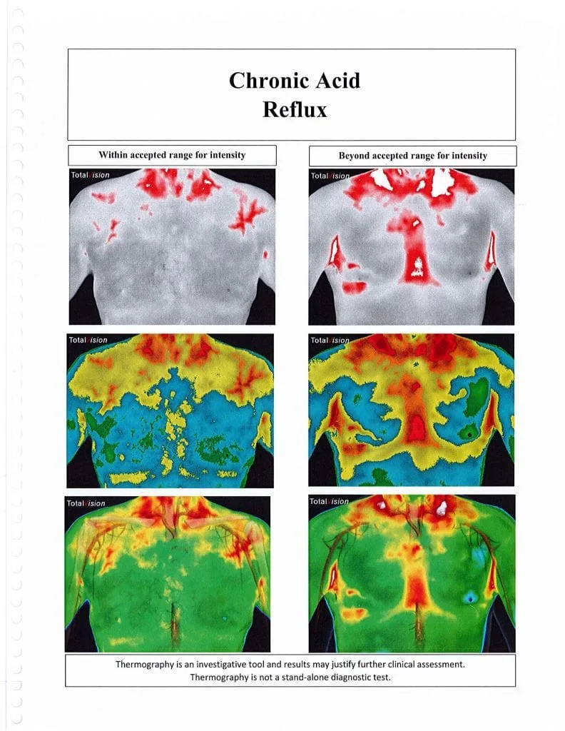 Thermography -- Chronic Acid Reflux