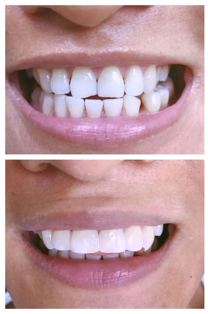 Aventura Dental Group specializes in full mouth aesthetic dental treatments including porcelain veneers, implants and many more. DM us for a cosmetic consultation.