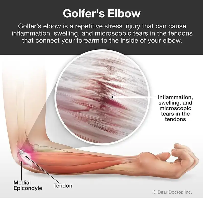Golfer's Elbow or Golf Elbow Pain Basalt CO