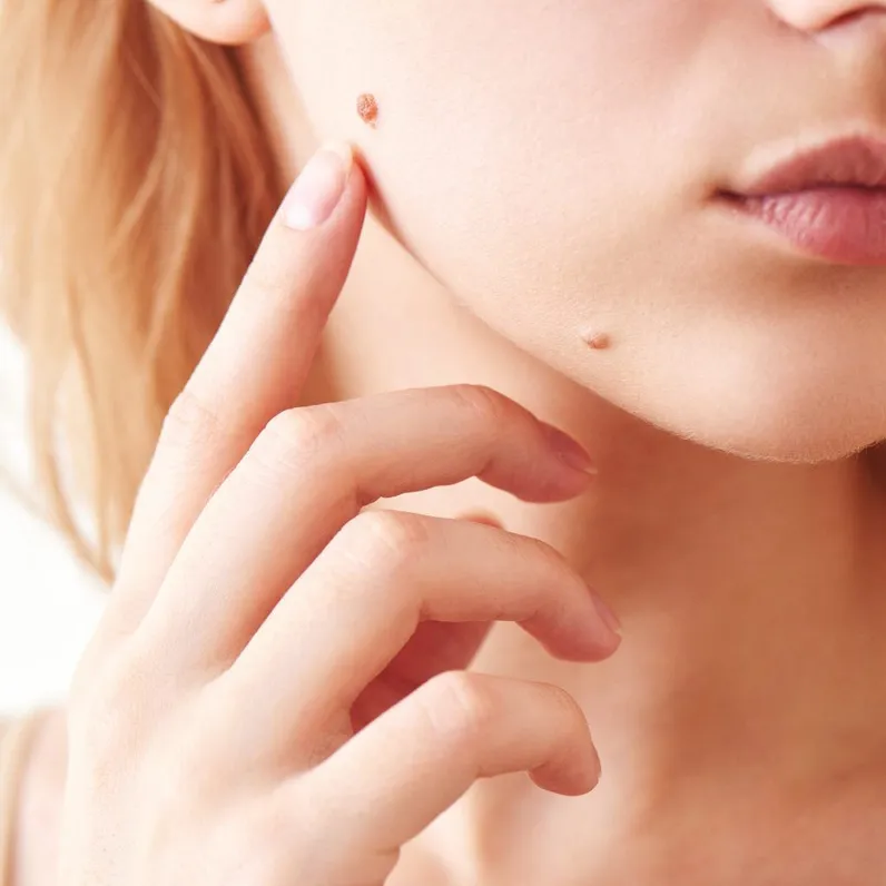 Mole Removal In Acworth Ga and Douglasville Ga