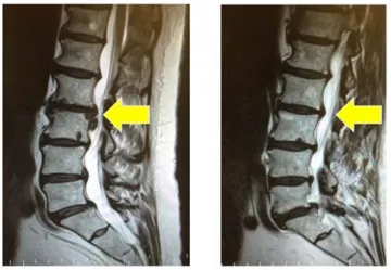 Spinal MRI