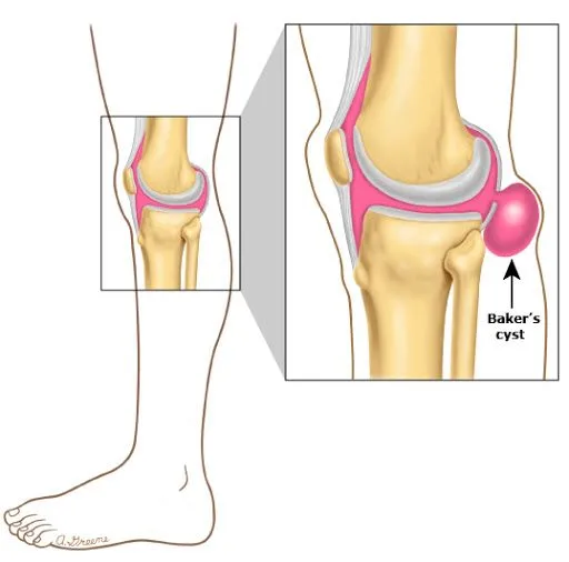 bakers cyst