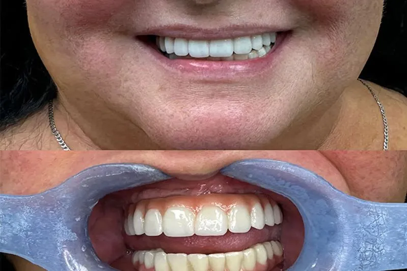 implants, teeth in a day, dental implants,