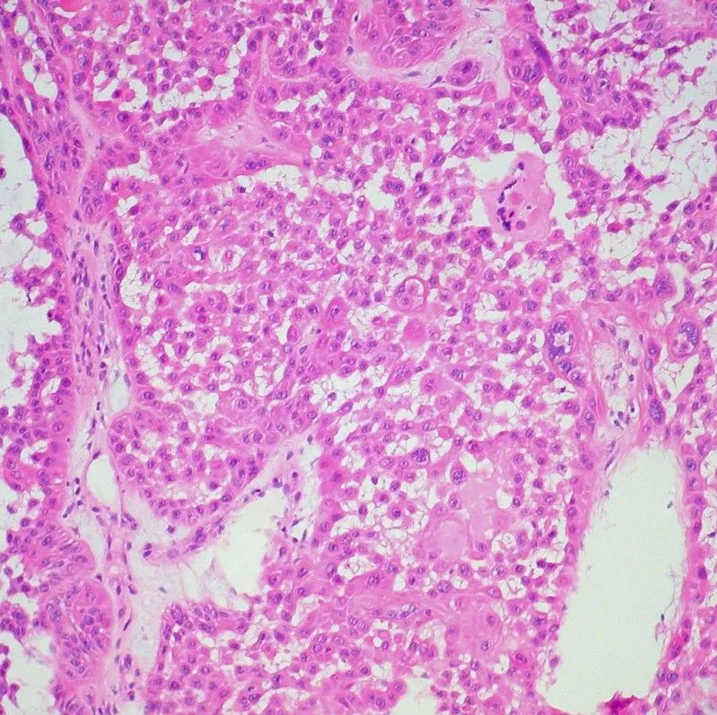 Squamous cell carcinoma