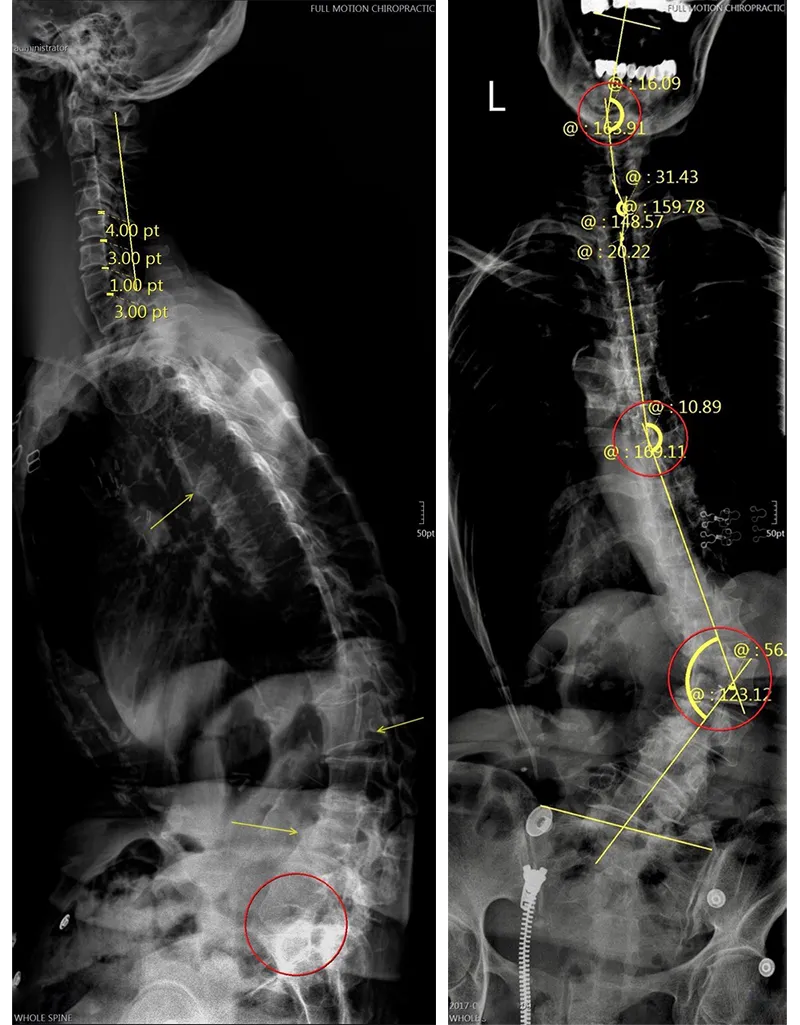 scoliosis xray