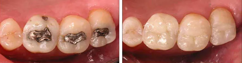 Amalgam fillings to Resin Fillings