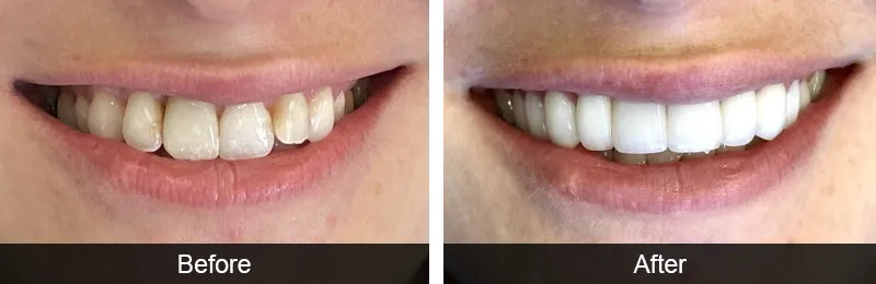 Dental Treatment Before & After Photos - Unfiltered Results