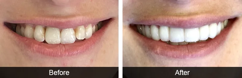 Full Mouth Rehabilitation Before and After Image, Honolulu and Oahu, HI