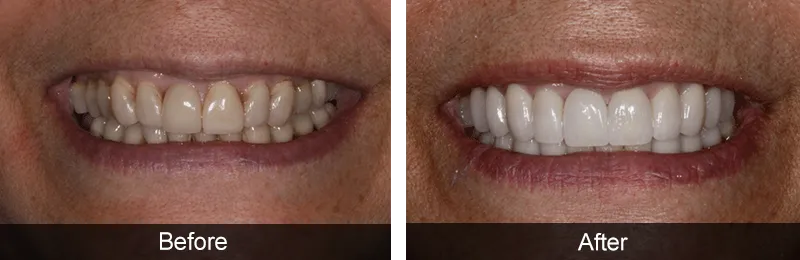 26 Celebrity Dental Implants and Veneers Before and After Photos