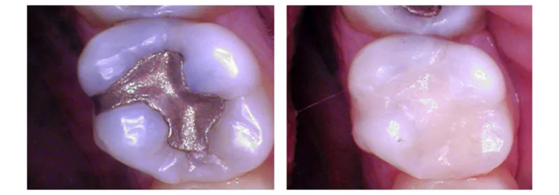 Tooth colored Fillings 