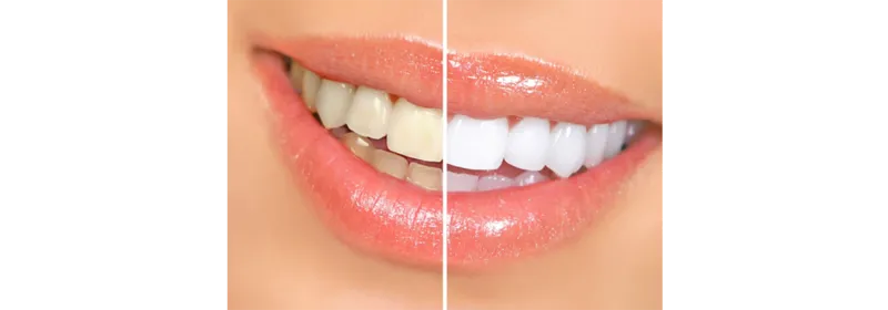  Teeth Whitening