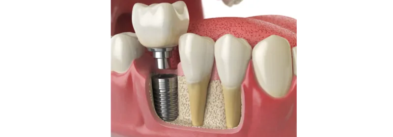 Implant restorations 