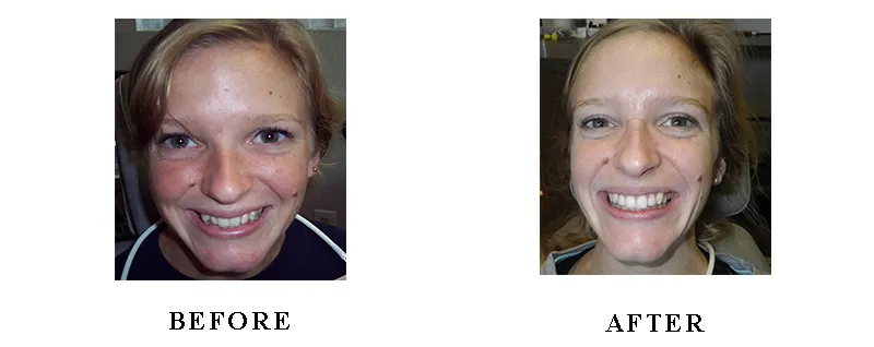 Invisalign Monroe, MI - Before & After